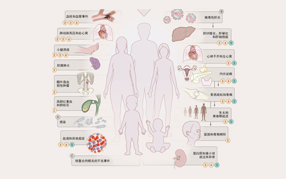 Common β-thalassaemia complications[5] (Image source: 2021 Prevention and Control of Global Hemoglobinopathies-Chinese Version)